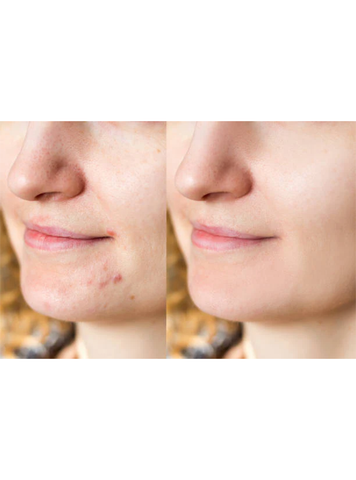 Anti Acne Serum - Trillium