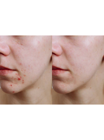 Gluta Pure C Anti Acne Face Wash - Trillium